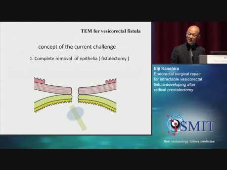 Reparación quirúrgica endorrectal para la fístula vesicorrectal intratable que se desarrolla después de la prostatectomía radical - SMIT 2019