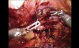 Reparación preperitoneal robótica de una gran hernia de Spigel en el contexto de un gran aneurisma de la aorta abdominal.