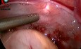 ¿Podemos darle un papel a la laparoscopia en el trauma?