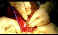 Inserción de prótesis de voz traqueoesofágica después de laringectomía