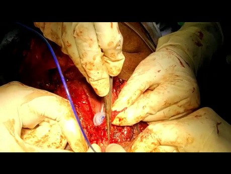 Inserción de prótesis de voz traqueoesofágica después de laringectomía