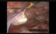 Extracción de nódulos ubicados en el tabique rectovaginal con histerectomía total laparoscópica 