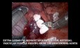 Secuestro pulmonar extralobar