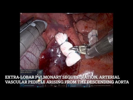 Secuestro pulmonar extralobar