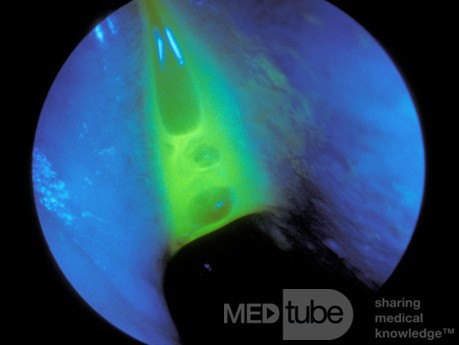 La prueba de fluoresceína para la rinorrea del LCR