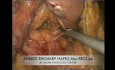 Whipple por vía laparoscópica - Pancreatoduodenectomía