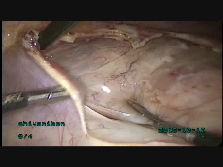 Mioma de 18 centímetros ubicado en el ligamento ancho del útero creciendo hacia el istmo