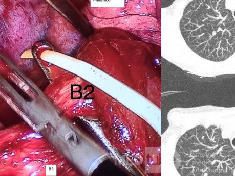 Segmentectomía derecha VATS S2