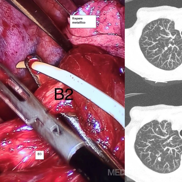 Segmentectomía derecha VATS S2