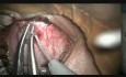 Cómo hacer una miomectomía oblicua inferior