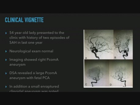 Manejo del aneurisma de la arteria comunicante posterior en presencia de variante fetal de la arteria cerebral posterior