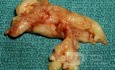 Papiloma invertido grande [muestra quirúrgica]