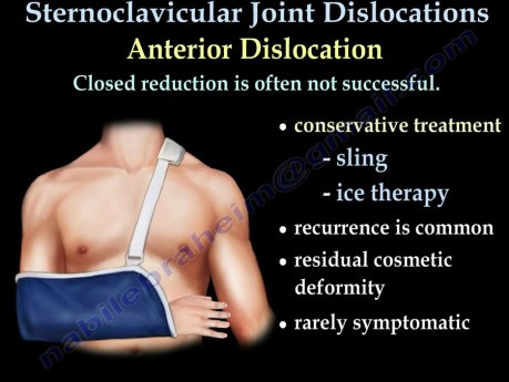 Lesiones por luxación sternoclavicular - video-clase