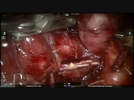 Lobectomia Media Robotica - Protocolo de Neoadjuvancia