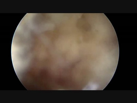 Abordaje lateral lejano en cirugía endoscópica de columna