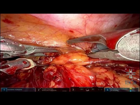 Una nueva estrategia: uretroplastia robótica término-terminal con ayuda de verde de indocianina y modo luciérnaga para localizar el punto de estrechamiento