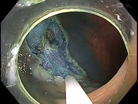 Cierre de defecto muscular después de la resección endoscópica de la mucosa (EMR) para  tumor de extensió lateral (LST) izquierdo de 20 mm