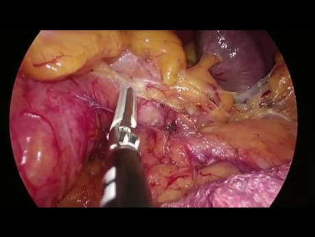 Escisión mesorrectal total (EMT) - Movilización de flexión esplénica medial a lateral