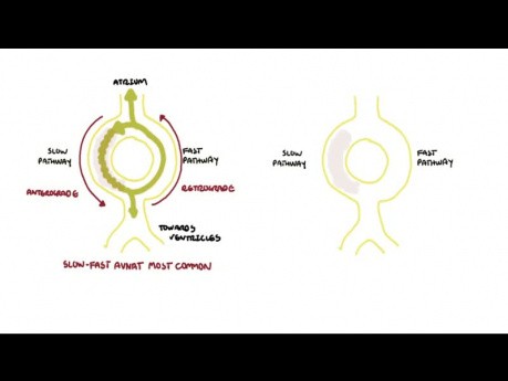 AVNRT (taquicardia de reentrada del nódulo auriculoventricular) - causas, fisiopatología, tratamiento