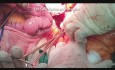 Preservación de la arteria rectal superior (abierta)