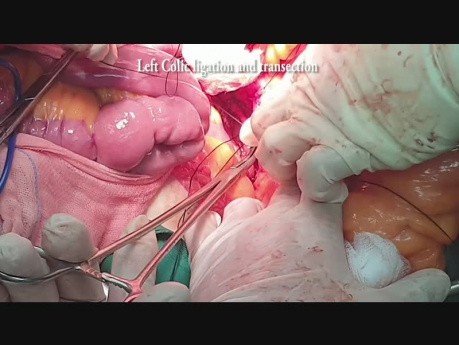 Preservación de la arteria rectal superior (abierta)