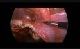 Resección laparoscópica de la trompa de Falopio torcida