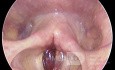 Hematoma de cuerdas vocales