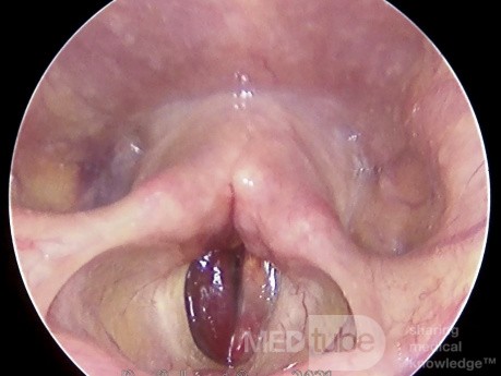 Hematoma de cuerdas vocales