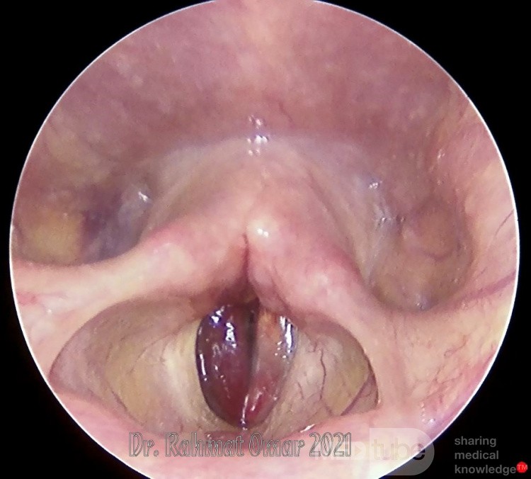 Hematoma de cuerdas vocales