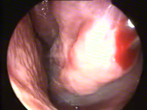 RDfrequencia turbinectomi