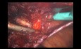TAPP ventral por laparoscopia combinada con TAPP inguinal (anotado)