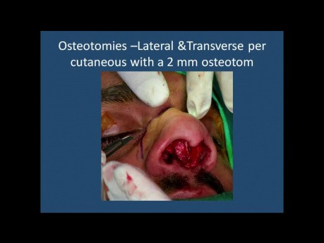 Clases de rinoplastia - la nariz "telescópica" (telescoping nose)