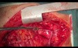 Reintervención de Cirugía de Revascularización Coronaria (CABG) en un paciente con FEVI del 5-10%