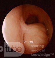 Pólipo coanal que surge del tabique nasal posterior izquierdo