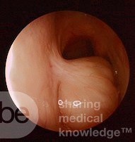 Pólipo coanal que surge del tabique nasal posterior izquierdo