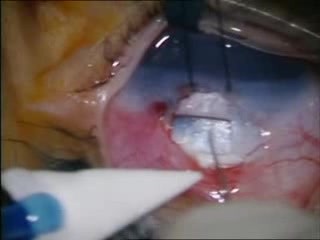 Trabeculectomía por glaucoma congénito