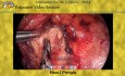 Resección laparoscópica de carcinoma adrenocortical recurrente adyacente al hilio renal y vasos mesentéricos principales