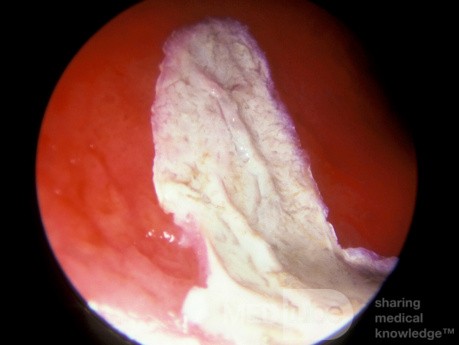 Cauterización del tabique nasal con nitrato de plata