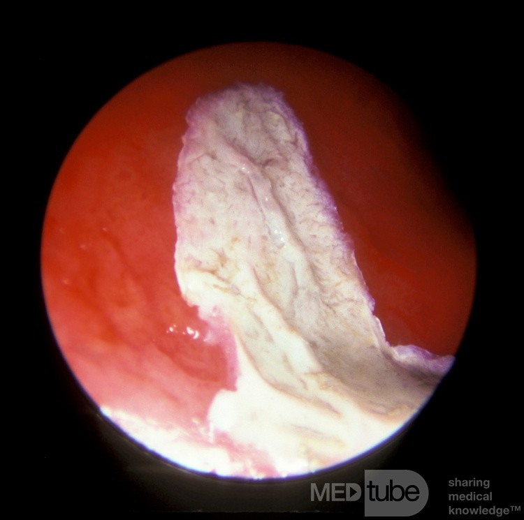 Cauterización del tabique nasal con nitrato de plata