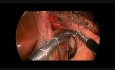 Cardiomiotomía de Heller laparoscópica complicada por perforación de la mucosa esofágica