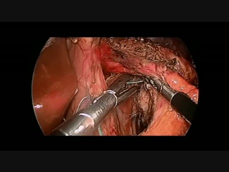 Cardiomiotomía de Heller laparoscópica complicada por perforación de la mucosa esofágica