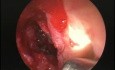 Sinusotomía esfenoidal de la pared anterior - endoscopia