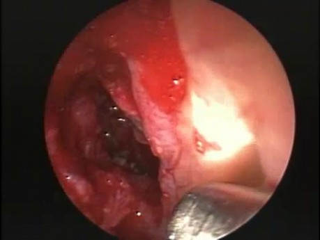 Sinusotomía esfenoidal de la pared anterior - endoscopia