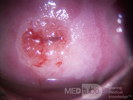 Colposcopia - CIN1