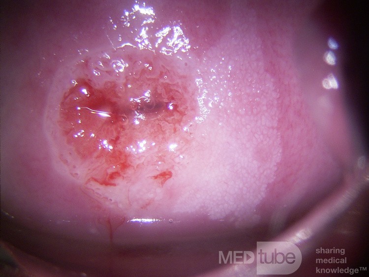 Colposcopia - CIN1