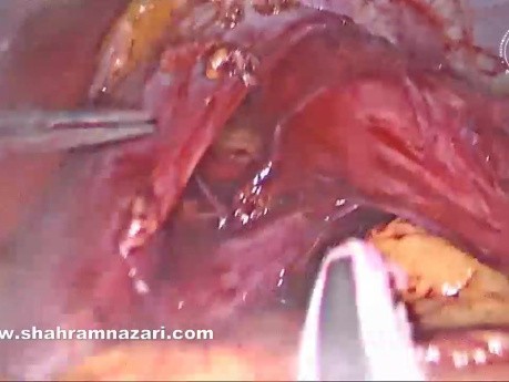 Miotomía de Heller laparoscópica y funduplicatura de Dor para el tratamiento de la acalasia