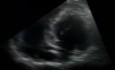 Caso de ecocardiograma de miocardiopatía hipertrófica