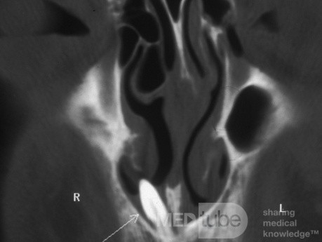 Diente que se proyecta a través del piso de la cavidad nasal [tomografía computarizada]