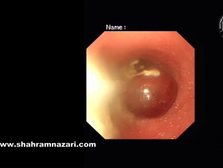 Impacto masivo de los alimentos en la acalasia