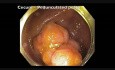 Complicaciones de la resección mucosa endoscópica (RME) - sangrado del ciego - video A